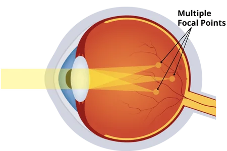 astigmatism_vision_lasik