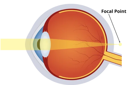 hyperopia_vision_lasik