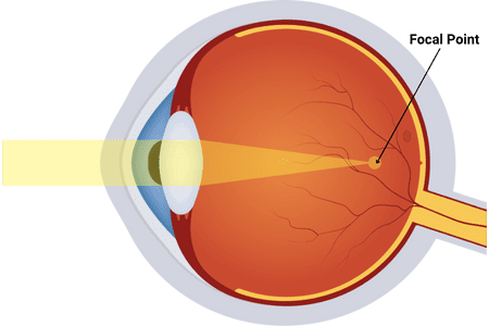 myopic vision