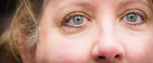 What Is The General Recovery Time For Keratoconus?