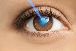 What Is The Success Rate Of Intra LASIK?