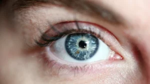 Astigmatism After LASIK