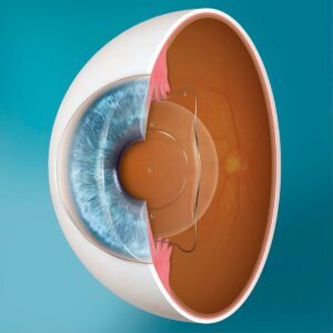 What Are Implantable Collamer Lenses (ICL)?