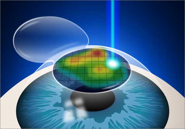 Custom Wavefront LASIK: A Revolutionary Approach to Vision Correction
