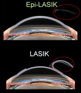 Difference Between Epi LASIK And LASIK