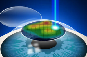 Introduction to Custom Wavefront LASIK