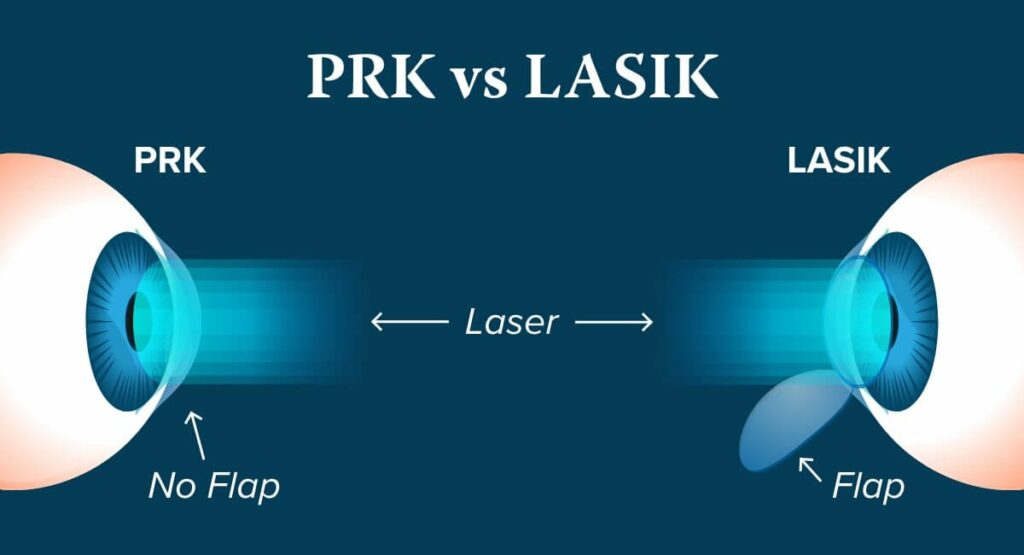 LASIK And PRK