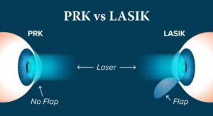 LASIK And PRK