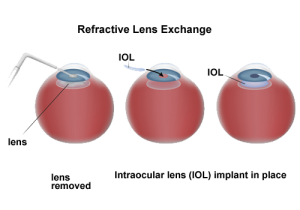 Unraveling the Costs: An In-depth Look at Refractive Lens Exchange Surgery