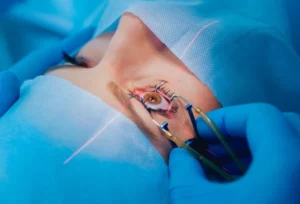 Laser Refractive Surgery