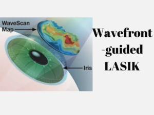 Traditional LASIK vs. Custom Wavefront LASIK