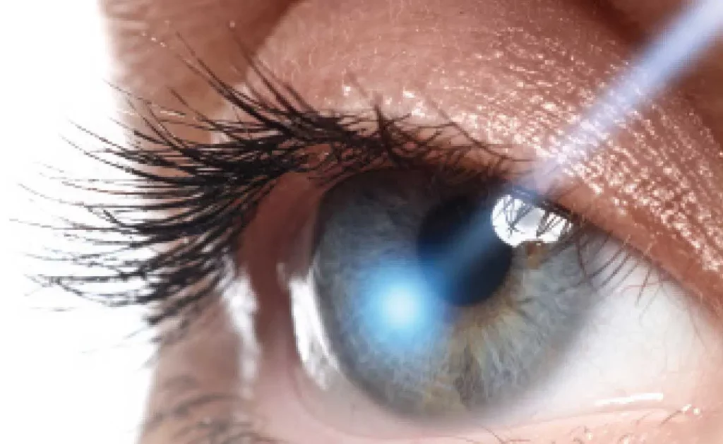 Understanding the Connection Between LASIK and Glaucoma