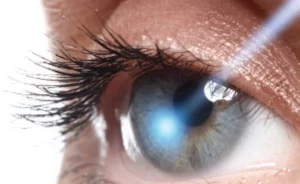 Understanding the Connection Between LASIK and Glaucoma