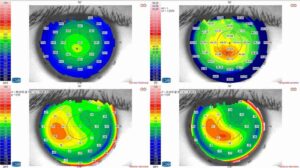 What Are Topography Maps In LASIK?