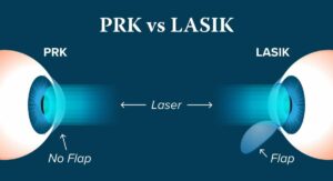 What Is Better For Astigmatism: PRK or LASIK?