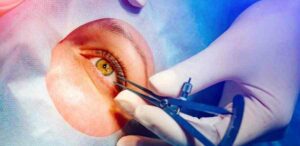 What Is LASIK?