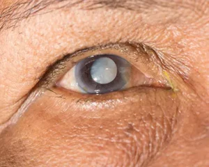 Cataracts Development Post-LASIK Surgery