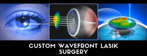 customvue lasik