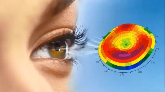 Topography Guided LASIK