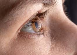 What Are The Risks Of Having Keratoconus And LASIK?