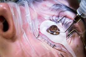 lasek eye surgery