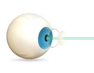 potential risks and complications associated with bladeless LASIK