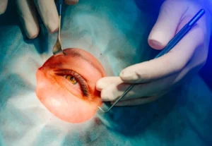 What Is Laser Refractive Surgery?