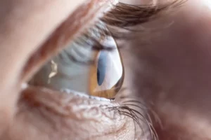 thin cornea prk