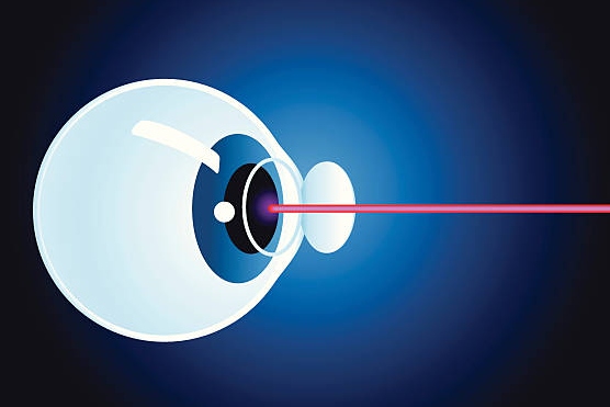Navigating Keratoconus and LASIK: A Comprehensive Guide