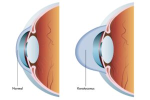 How Are PRK And CXL Different For Keratoconus?