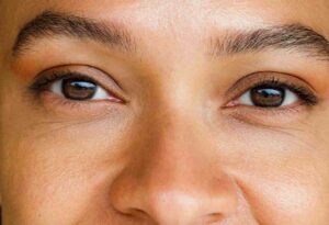 Revolutionizing Keratoconus Treatment: A Close Look at PRK and CXL