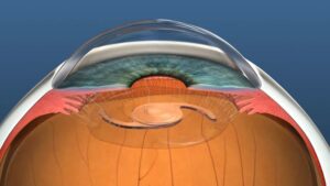 Is Clear Lens Exchange Safe?