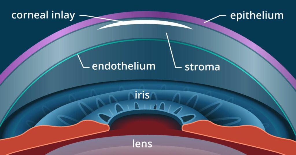 Alternatives to LASIK and PRK : Types and How To Choose?