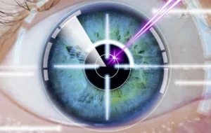 Benefits Of Femto Excimer Laser Surgery?