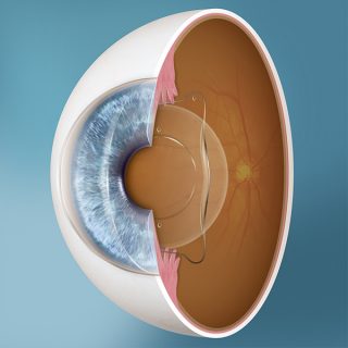 Who Is A Eligible Candidate For This Surgery?