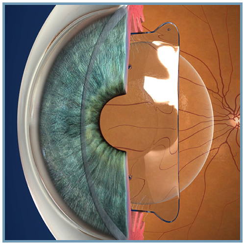 Evo+ Visian ICL: A Revolutionary Solution for Vision Correction