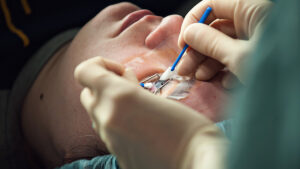 Flapless LASIK