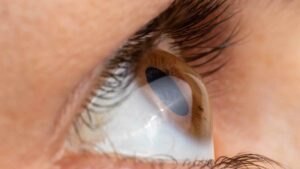 Understanding Keratoconus