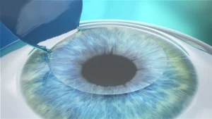 How Femto Excimer Laser Surgery Works?
