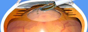 ICL Contact Lenses