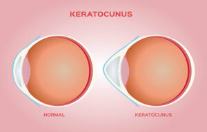 Illuminating a Path: Topography-Guided PRK for Managing Keratoconus