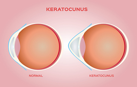 Illuminating a Path: Topography-Guided PRK for Managing Keratoconus