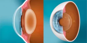 Clear Lens Exchange Procedure