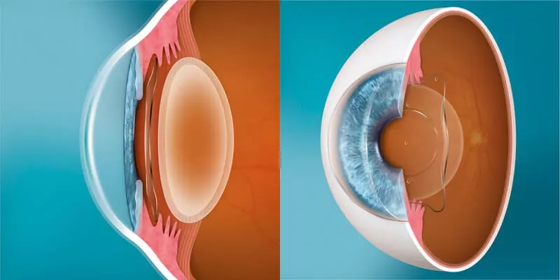 Clear Lens Exchange Procedure