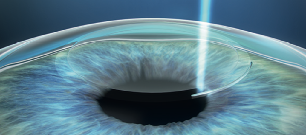 Monovision for LASIK