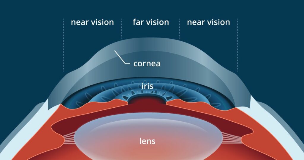 Presbyopia after LASIK