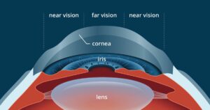 Presbyopia after LASIK