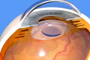RLE Vision Correction : Finding RLE Vision