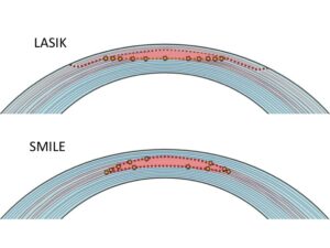 Smile Lasik for Thin Corneas