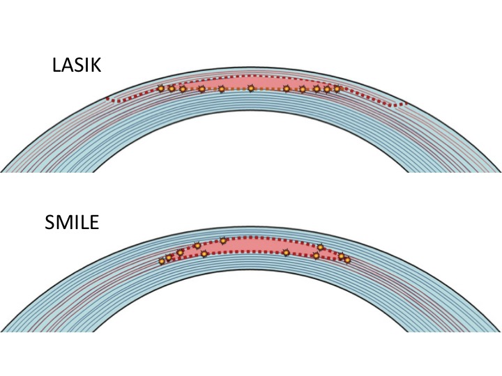 Smile Lasik for Thin Corneas